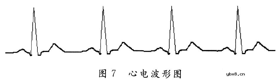 简易心电图仪的设计