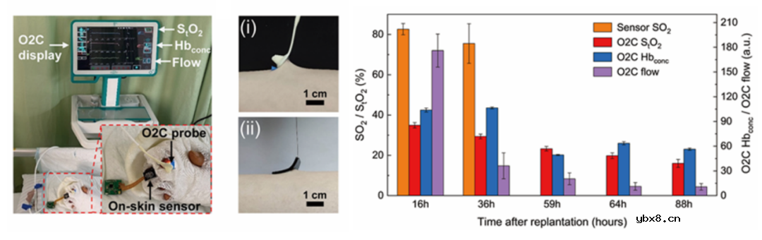 小型化表皮生物传感器用于术后血运状态持续监测
