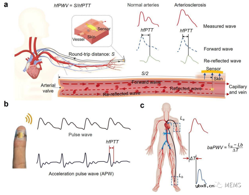 基于可穿戴离子电子传感器单点指尖脉冲监测的动脉硬化评估