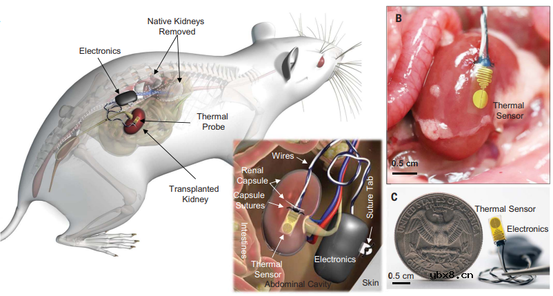 用于肾移植排斥反应早期检测的植入式柔性生物电子系统设计