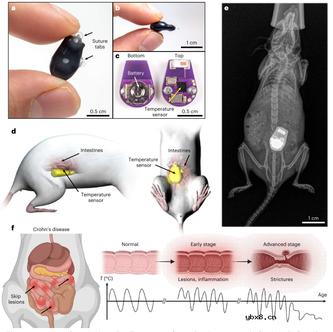 用于长期监测慢性肠道炎症的微型植入式温度传感器