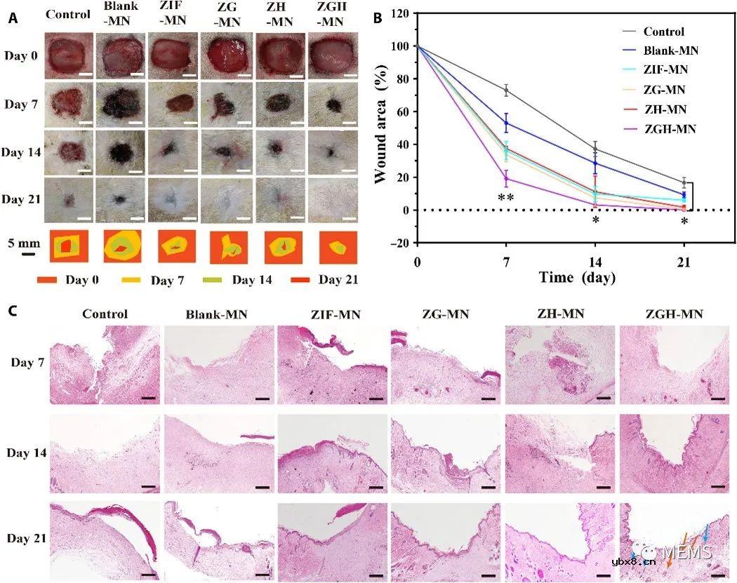 用于糖尿病创面的防疤痕愈合的自供电酶联微针贴片